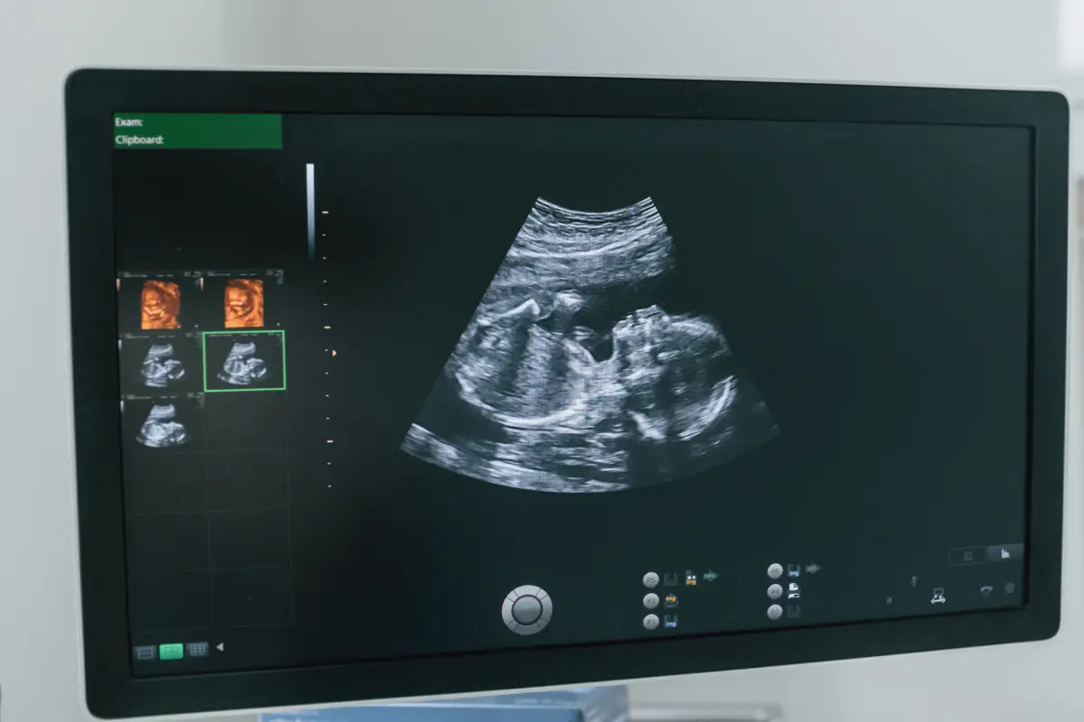 Le mécanisme fascinant derrière une échographie de grossesse : comprendre son fonctionnement étape par étape
